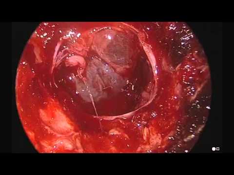 Endoscopic Removal of Pituitary Macroadenoma