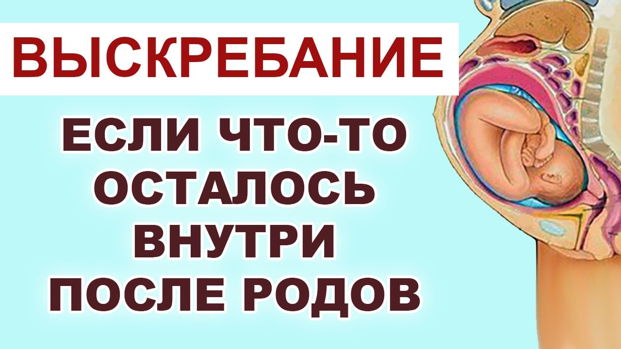 Очищение матки после родов. Как делают Помогут ли травы Диагностика.