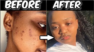 How to get rid of ACNE SCARS in 3 DAYS! 🇿🇦🇧🇼🇸🇿🇱🇷🇱🇸🇿🇼🇺🇸|| Thebarbie