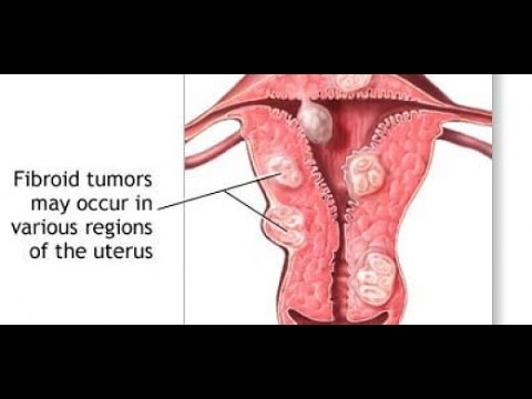 Kung paano mangayayat matapos cesarean video Manood ng libreng video para sa pagbaba ng timbang fitness