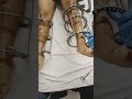 Height Increase Surgery Surgery For Height Limb Lengthening Surgery In Delhi