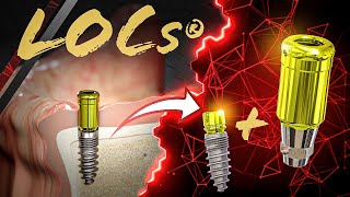 CHAMPIONS LOC® Abutments erklärt: Funktionsweise und Anwendung