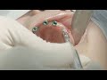 Technology used to fix injured knees now used for dental implants