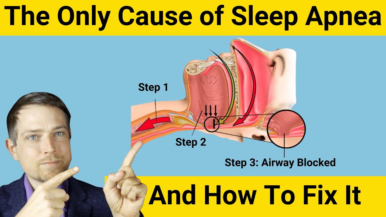 Why Obstructive Sleep Apnea Only Has One Cause and How to Fix It