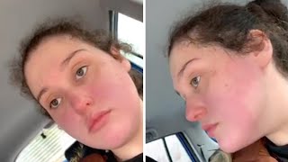 Woman Is Allergic to McDonald's