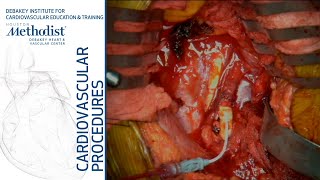 Download Lagu Obturator Bypass (Maham Rahimi, MD, Luis Gomez, MD) Thumbnail