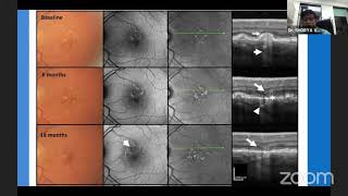 Download Lagu AIOS ARC Enhancing Concepts OCT u0026 OCT... Dr SHORYA VARDHAN AZAD Thumbnail