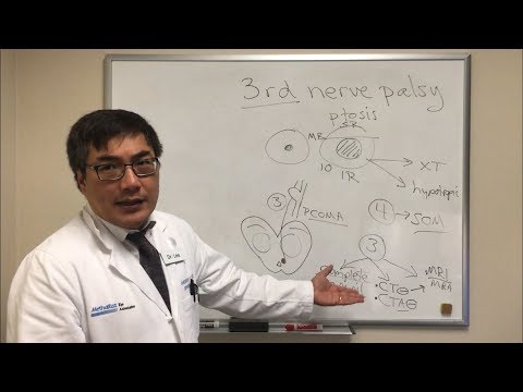 Cranial Nerve 3 (CN III) Palsy