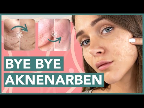 Aknenarben entfernen - so kannst Du sie einfach zuhause selbst  behandeln