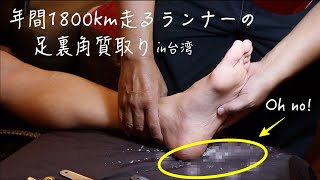 【台湾】大雪注意報！年間1800km走るランナーの足うら角質取り〜後半は巻き爪カット〜