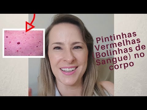 Pintinhas Vermelhas ou Bolinhas de Sangue no corpo - Dra Cínthia Orasmo