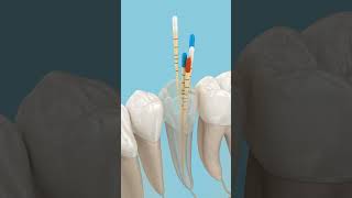 Dental root canal filling procedure. 3D Animation