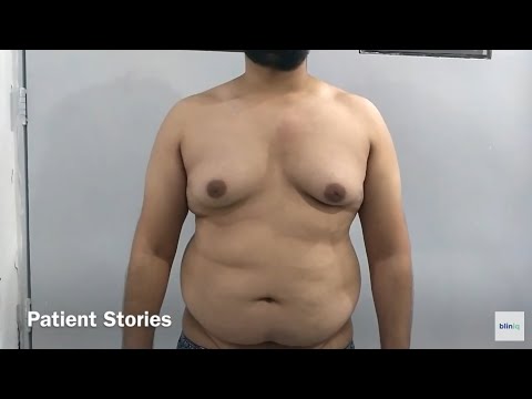 Patient Recovery Case — Video 33 (Gynecomastia)