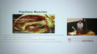 Anatomy and pathologies of the mitral valve – Dr Sean Lal