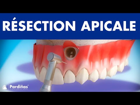 Résection apicale ©