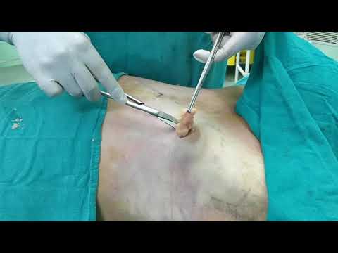 High-Definition Liposuction Experience