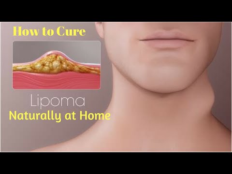 How to Treat Lipoma Without Surgery   How to Cure Lipoma   5 Ways to Get Rid of a Lipoma Naturally