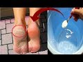 In Just 3 Minutes - Get Rid of CRACKED HEELS Permanently, Magical Cracked Heels Home Remedy