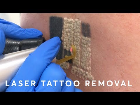 , title : 'Laser Tattoo Removal: PAIN, RESULTS & PROCEDURE'