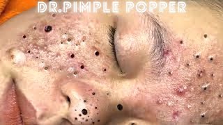 Treatment of Blackheads and Hidden Acne  dr pimple