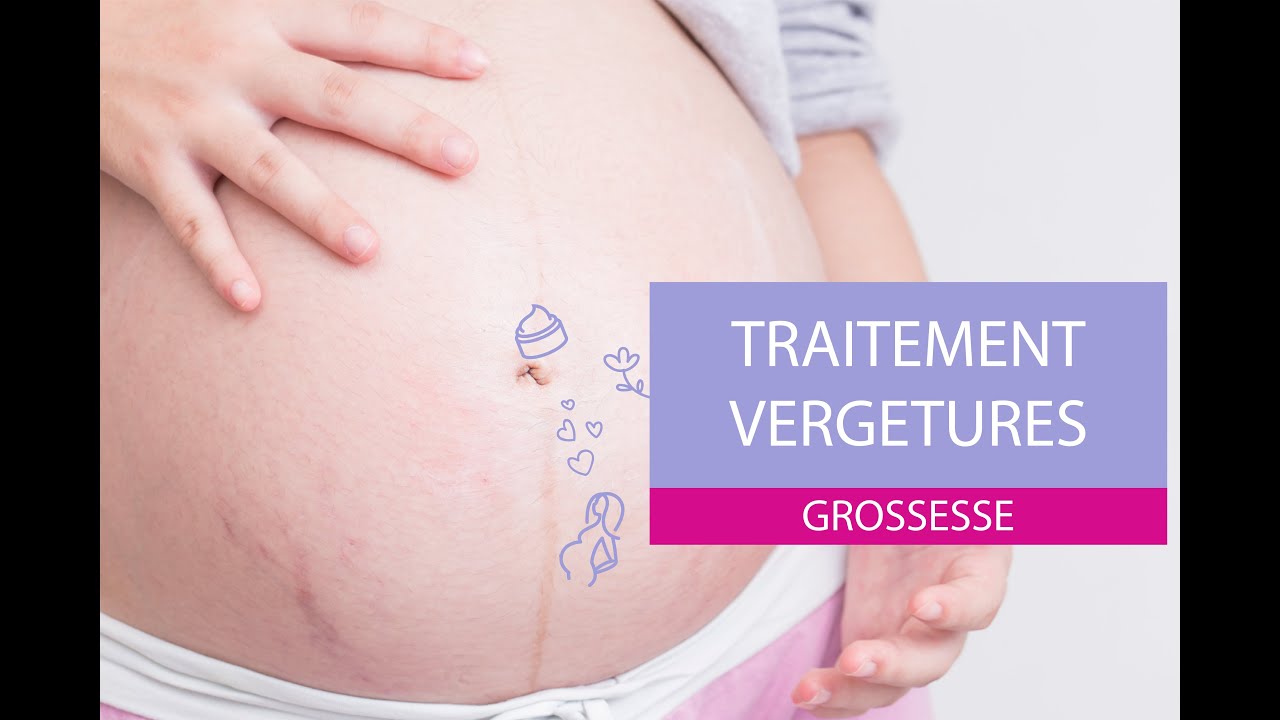 vergetures stretch marks