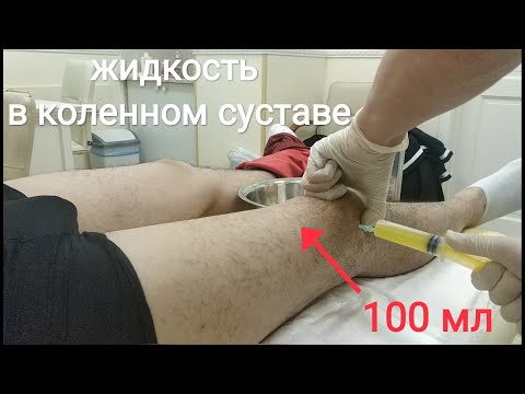 Жидкость в  колене 100 мл, нужно ли откачивать? Синовит, артрит. Манипуляция