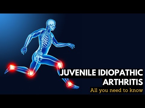 Juvenile Idiopathic Arthritis: Everything You Need To Know