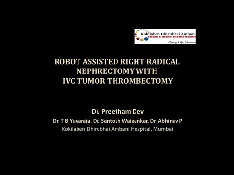 Nefrectomía radical robótica con trombectomía de la vena cava inferior