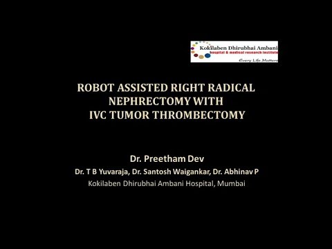 ROBOT ASSISTED RIGHT RADICAL NEPHRECTOMY WITH LEVEL II INFERIOR VENA CAVA TUMOR THROMBECTOMY