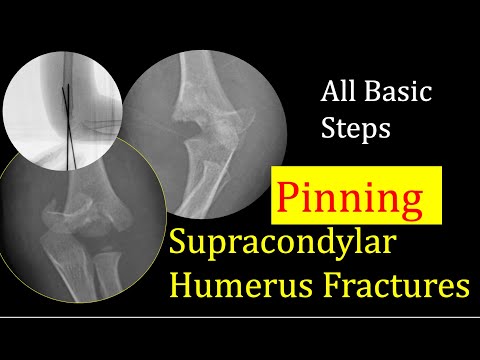Supracondylar Humerus Fractures: Basic Simple Steps for pinning/K wire
