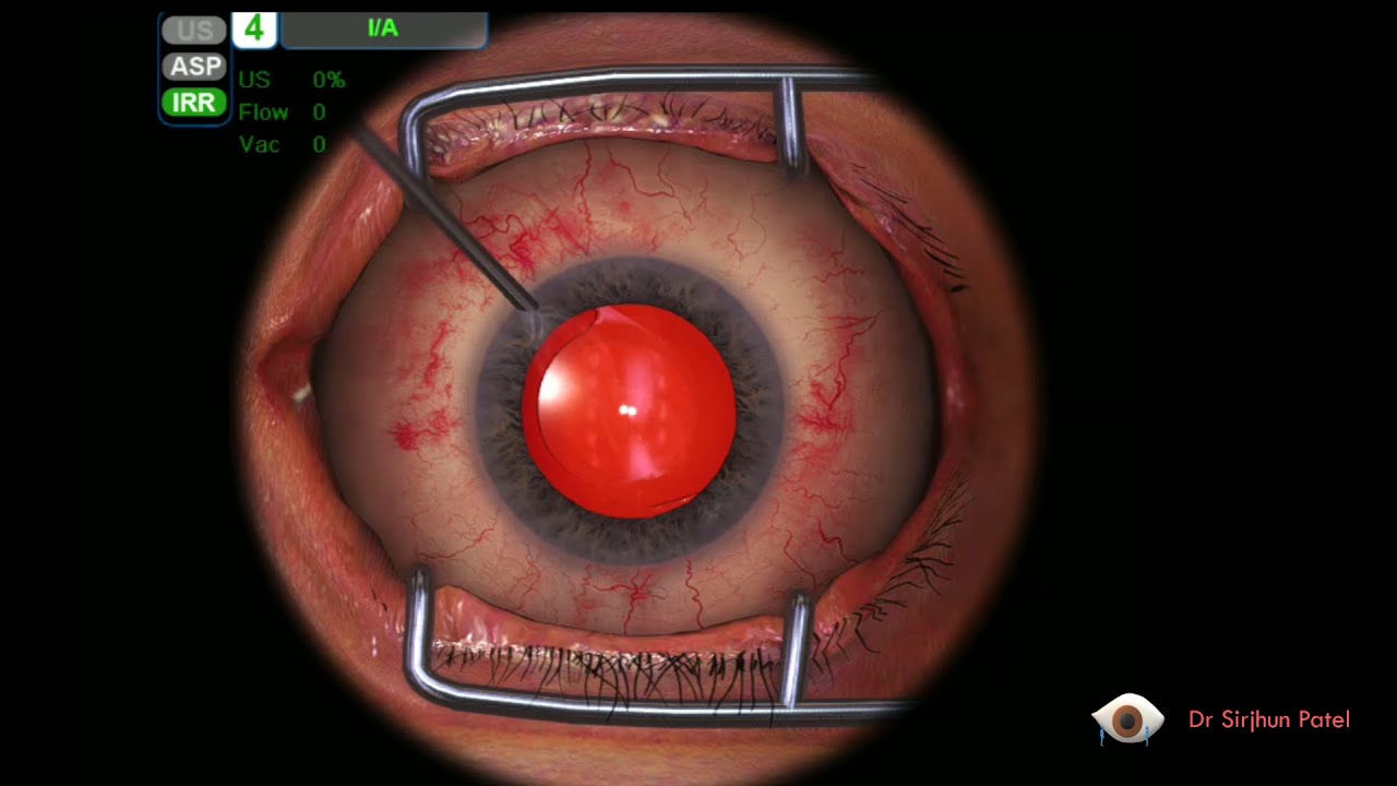 Eye Surgery Simulator - Cataract - Patient Guide
