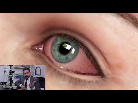 What is Dry Eye Disease and how to treat Dry Eyes