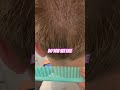 Do you see lice? l Lice Removal Service l #explore #headliceremoval #hair #liceremoval