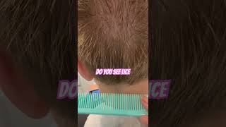 Do you see lice? l Lice Removal Service l #explore #headliceremoval #hair #liceremoval