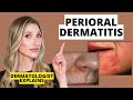 Dermatologist Explains Perioral Dermatitis What It Looks Like Causes Treatments Dr Sam Ellis