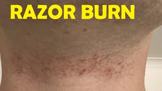 how to get rid of razor burn in an hour