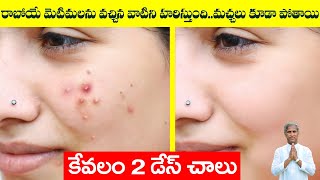 Pimples Removal On Face at Home | Thyme Oil Benefits | Dr Manthena Satyanarayana Raju Videos