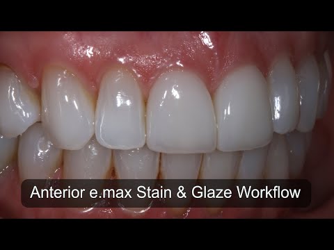 Anterior e.max Stain and Glaze Workflow for the CAD/CAM Dentists