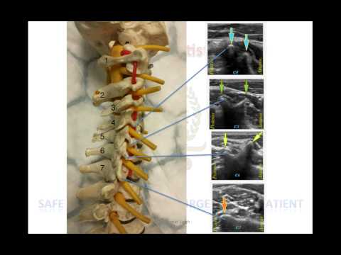 CERVICAL PLEXUS: ANATOMY, LANDMARK AND US GUIDED BLOCKS