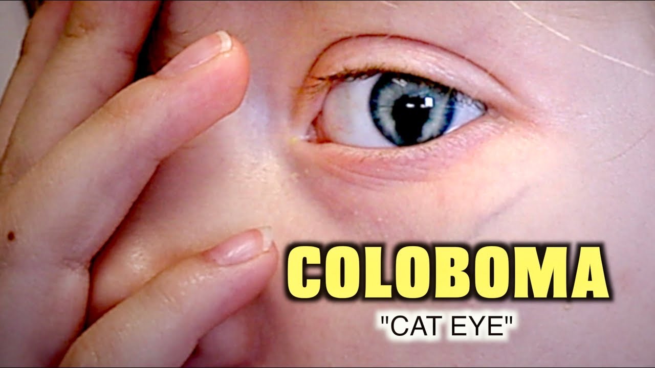 LITTLE GIRL WITH RARE COLOBOMA (Cat Eye) | Dr. Paul - YouTube