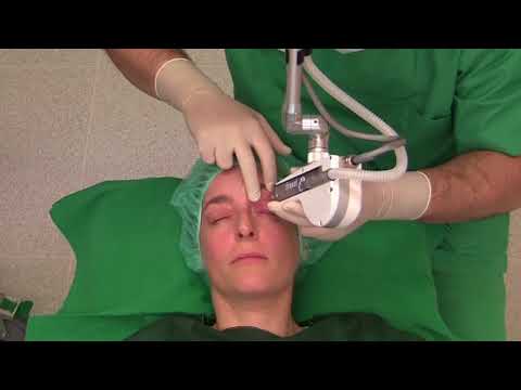 Augenlider straffen ohne OP - Fraxel Lidkorrektur mit Laser