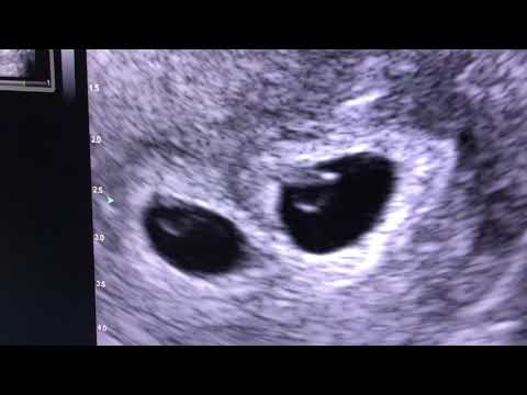 Sonogram: Twins at 5 weeks!