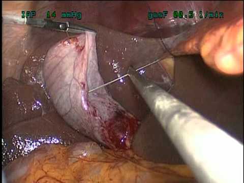 Laparoscopic Cholecystectomy - SILS