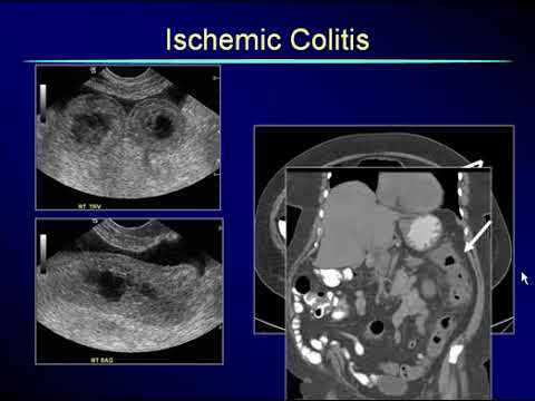 Non Gynecological Findings on Pelvic Scans 2