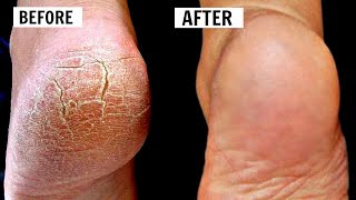 How to Get Rid of Cracked feet FAST & NATURALLY