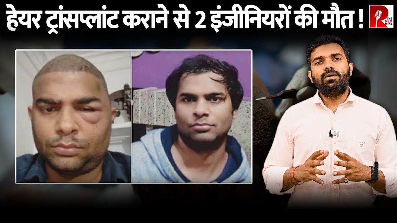 कानपुरः हेयर ट्रांसप्लांट से दो इंजिनियरों की मौत, डॉक्टर फ़रार, कैसे दिया धोखा?