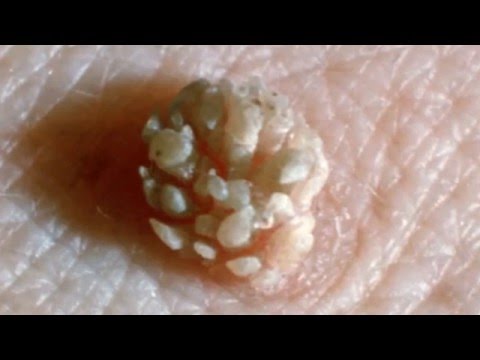 Amelyek a kezelés pinworms