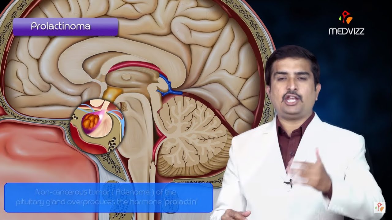 Prolactinoma Pathology USMLE Step 1 - Quick review - YouTube