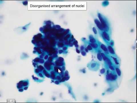 Cervical smear cytology - HSIL