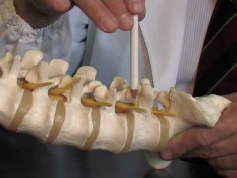 Tecnica video per il trattamento della malattia degenerativa del disco del video Bubnovsky cervicale Trattamento delle articolazioni mediche